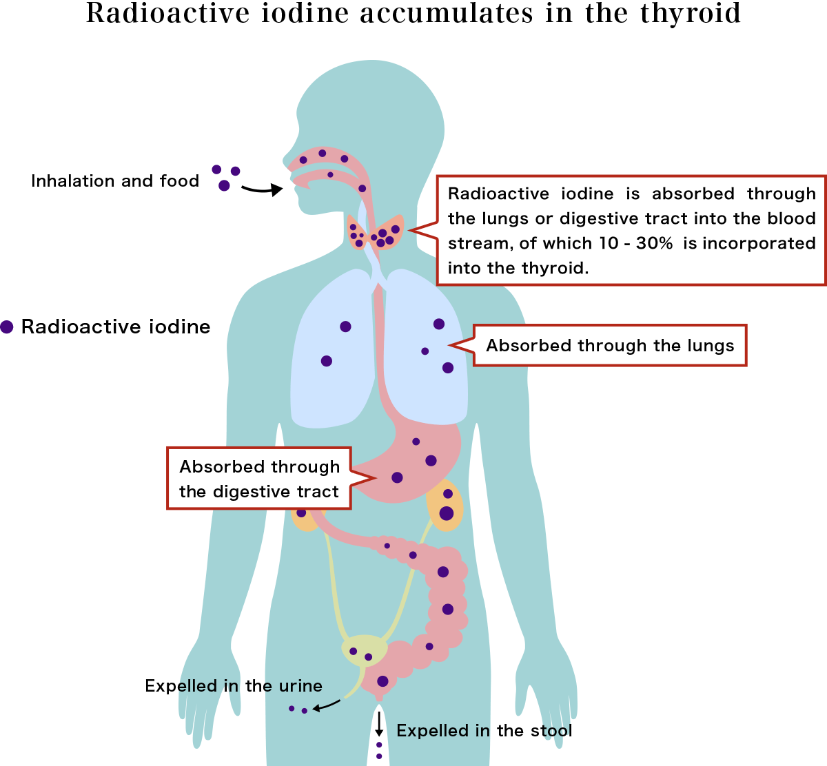 Radioactive iodine accumulates in the thyroid